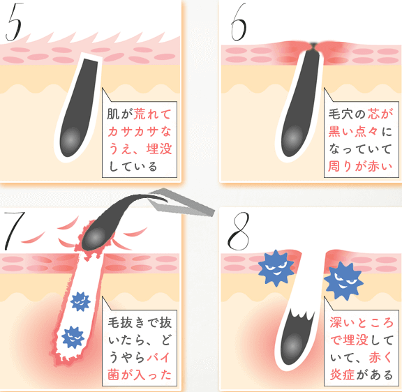 ストレミライン 埋没毛 肌荒れ ニキビ改善プロジェクト